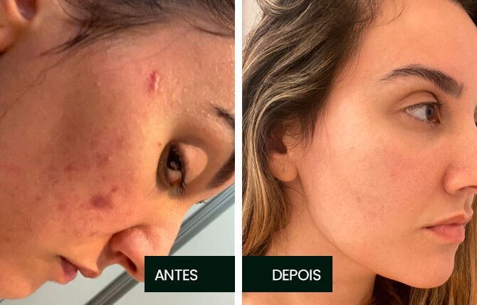 Antes x Depois