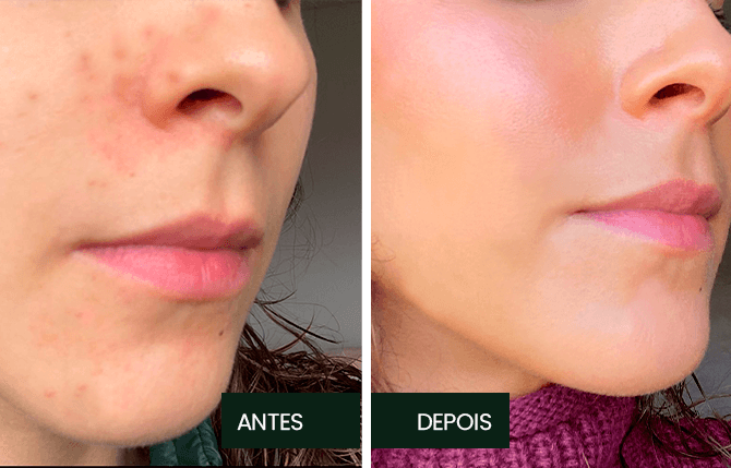 Antes x Depois