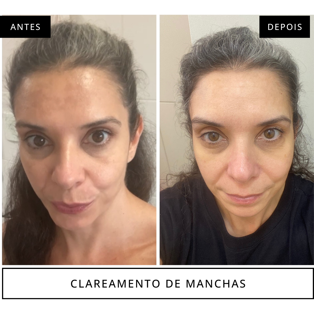 antes e depois clareamento de manchas