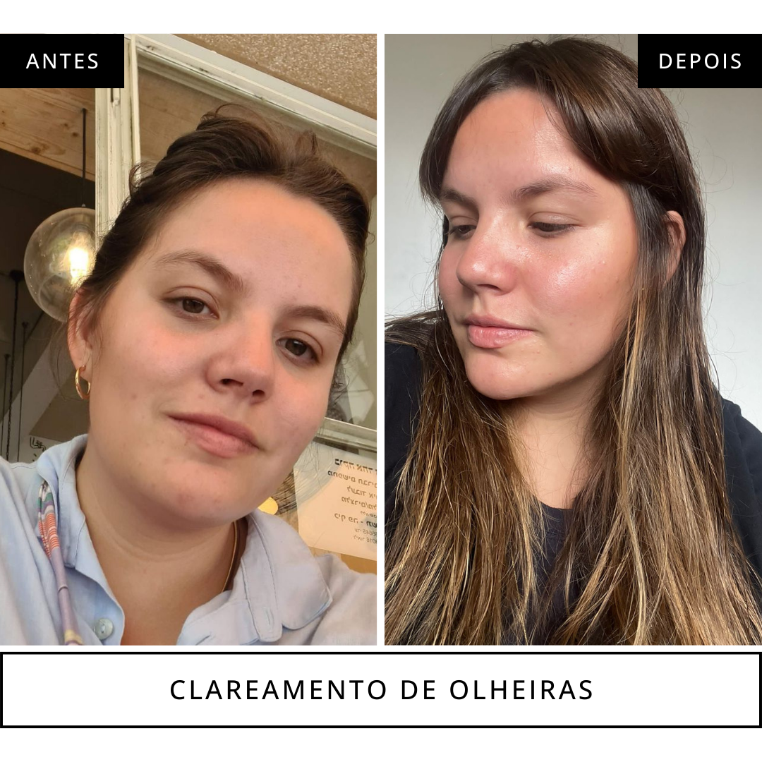 antes e depois clareamento de olheiras