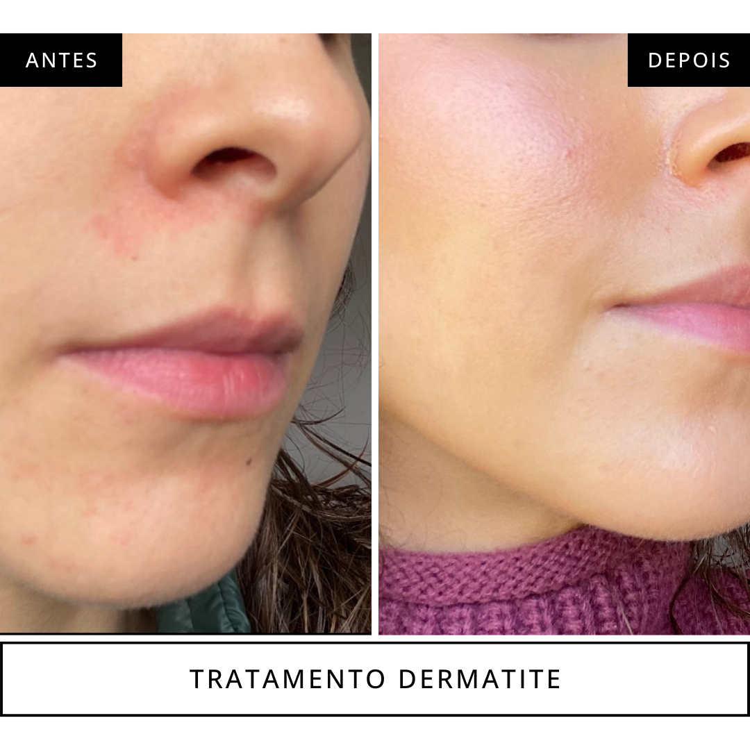 antes e depois tratamento dermatite